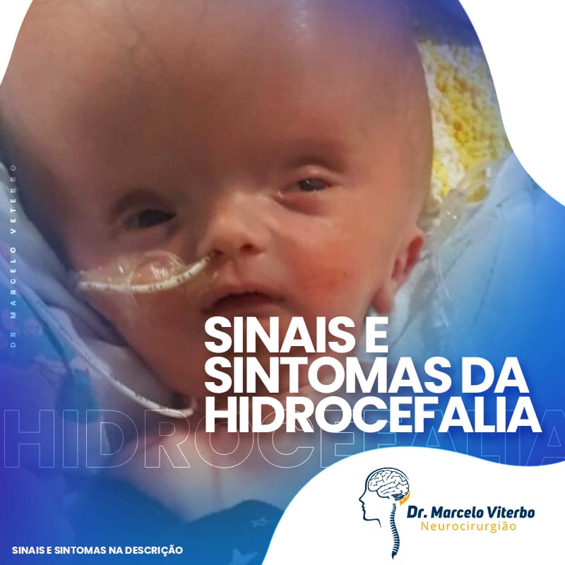Quais São Os Sintomas Da Hidrocefalia Dr Marcelo Viterbo 0275
