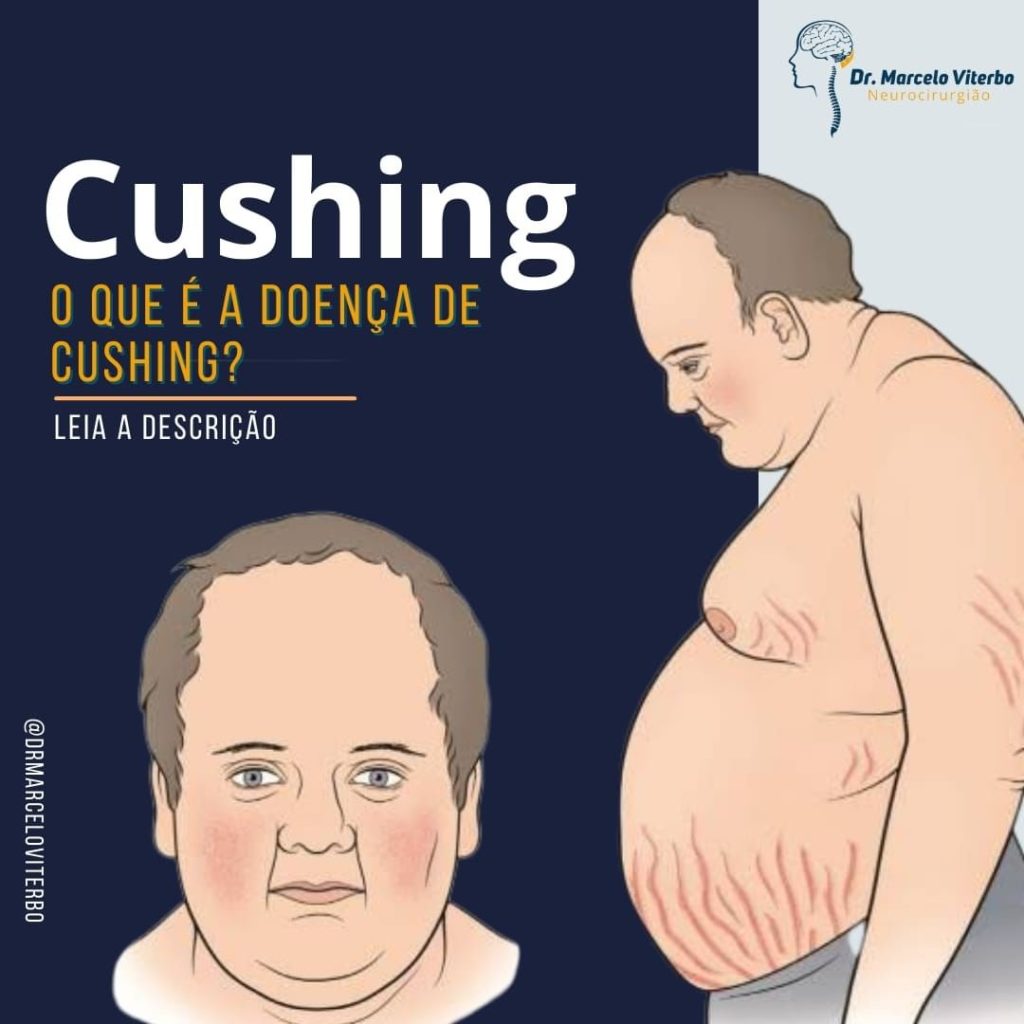 Sd De Cushing – Syndrome De Cushing Effets Secondaires – GMUW